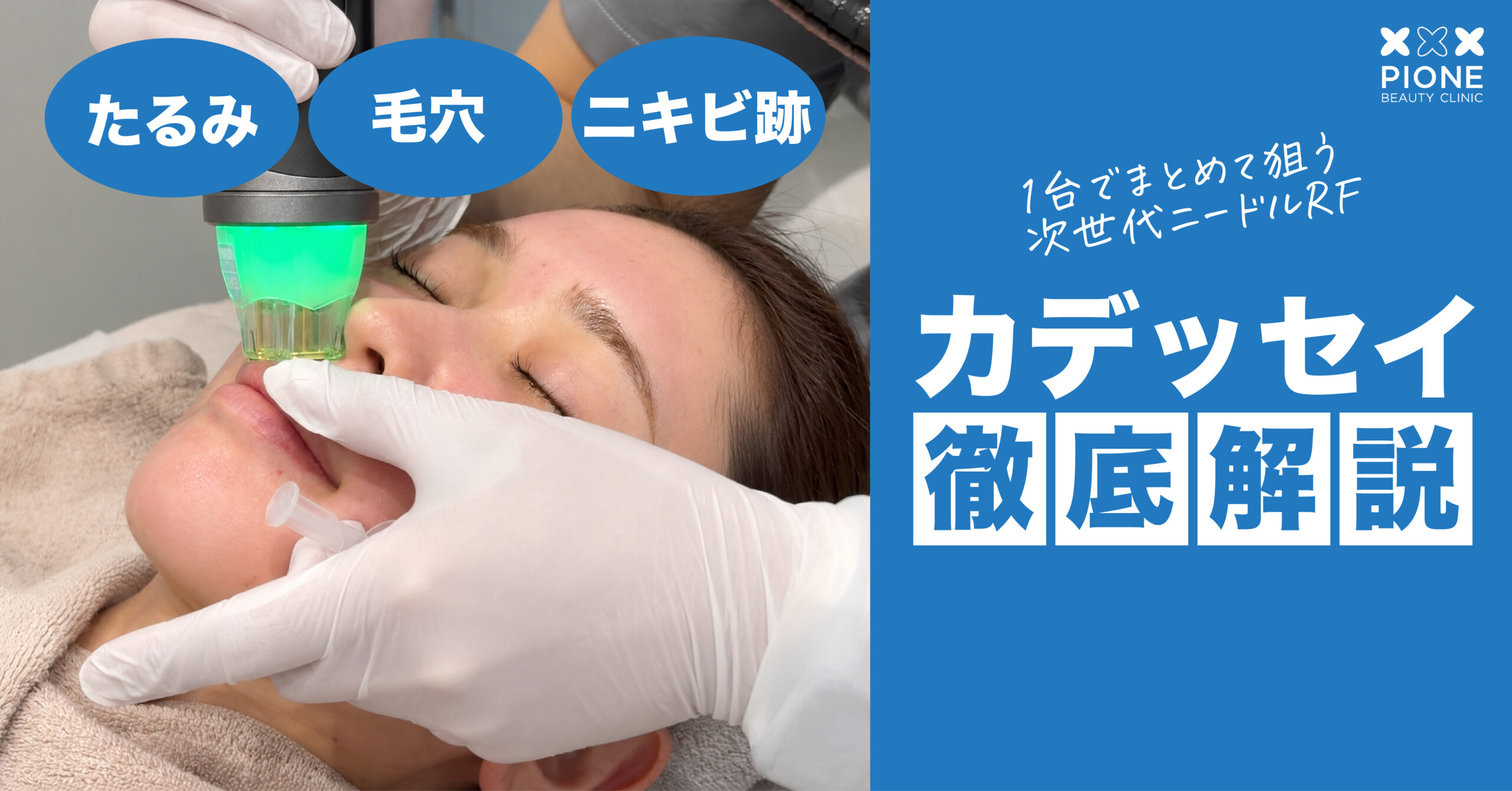 カデッセイ徹底解説：たるみ・毛穴・ニキビ跡を1台でまとめて狙う次世代ニードルRF